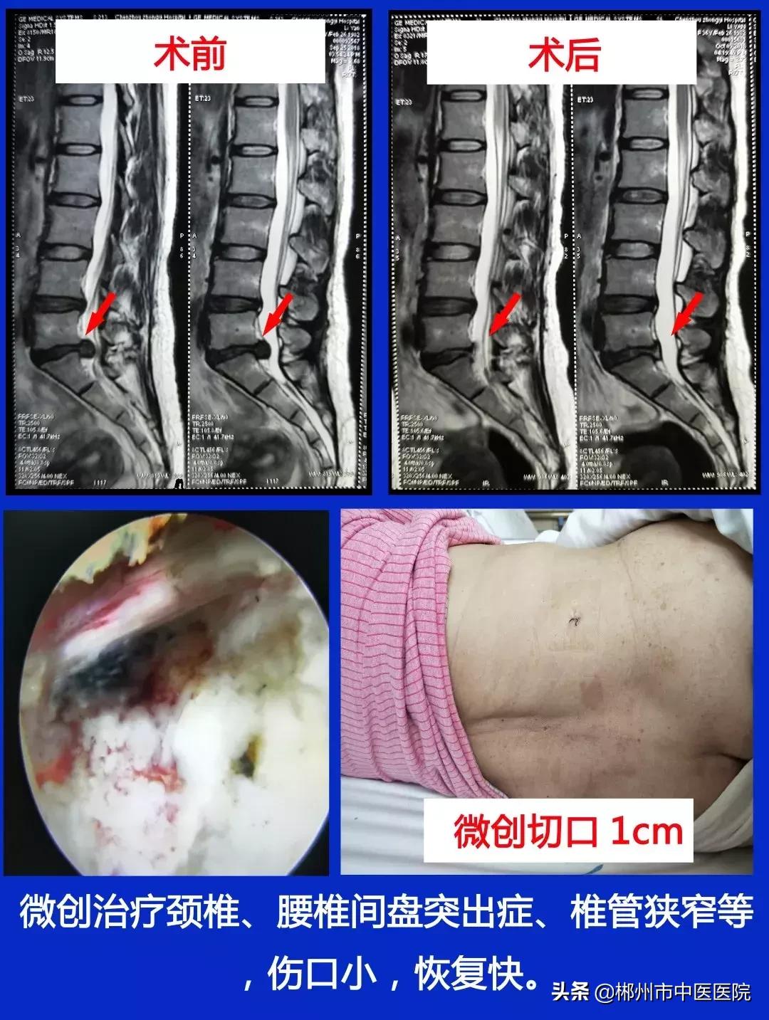 【谈骨论筋】脊柱微创为患者“撑腰”
