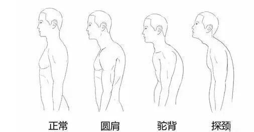 求实瑜伽丨驼背影响美观怎么办？瑜伽理疗来帮忙