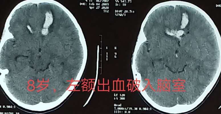 脑动静脉畸形可选用的栓塞物,脑动静脉畸形做伽玛刀后康复