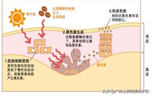 对付褐黑色痘印,对付黑痘印最有效的成分