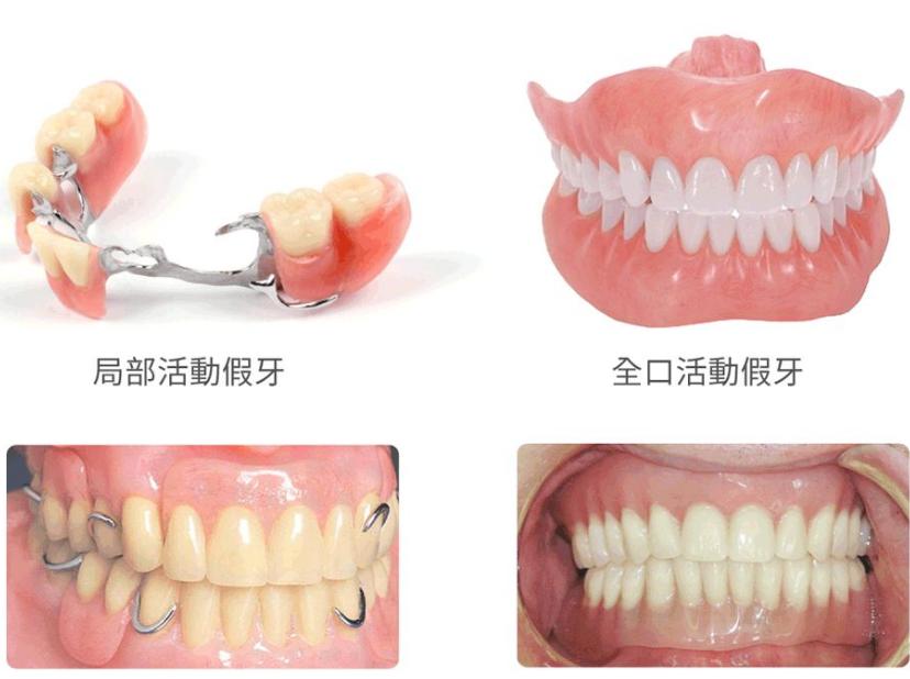 有舒服的活动义齿吗,装一颗活动义齿最舒服的是哪一种