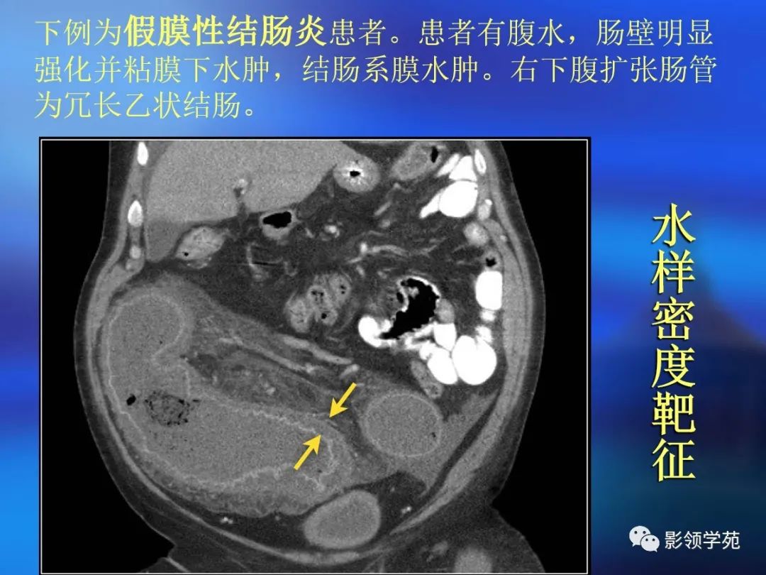 肠道内壁增厚,肠道扩张ct表现