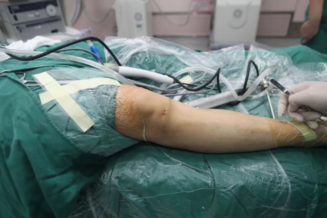 南大二附院骨科郝亮博士赴医联体单位指导完成一例关节镜手术