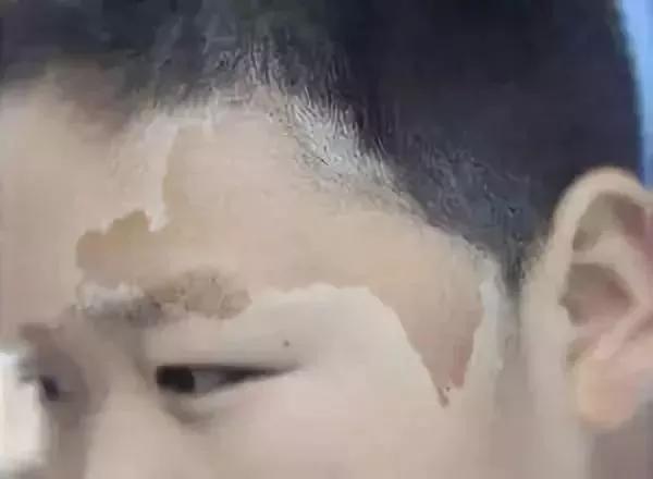 常见皮肤色斑有哪些如何鉴别,如何区分脸上色斑类型图片