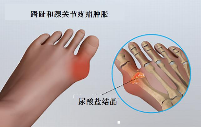 痛风病人应当避免吃哪些食物？