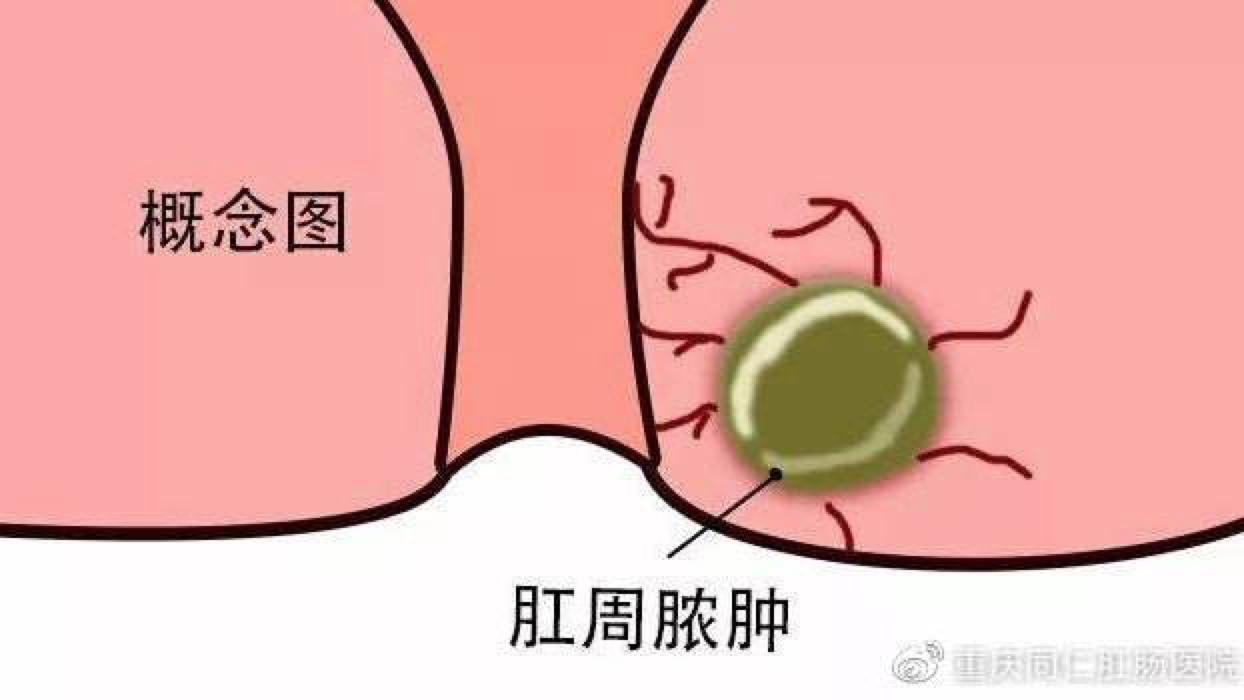 鑲涘懆鑴撹偪鐢ㄦ墜鏈悧,鍋氬畬鑲涘懆鑴撹偪鎵嬫湳