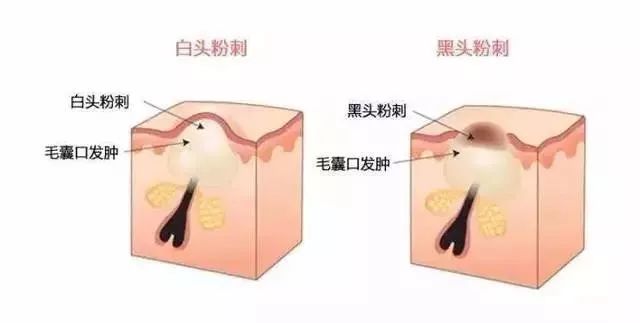 棰濆ご绮夊埡闂彛鎬庝箞鍘婚櫎,鍘婚櫎闂彛绮夊埡鐨勬姢鑲ゅ搧