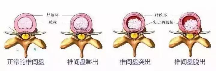 一文说清！腰椎间盘膨出、突出、脱出的区别，别再盲目开刀了