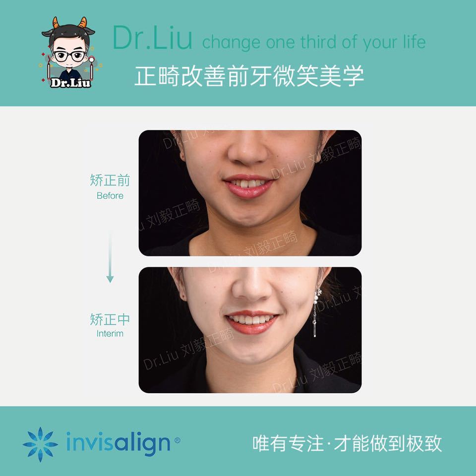 厦门牙齿矫正刘毅：戴牙套真的变化很大吗？（附正畸案例说明）