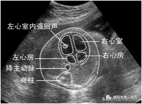 四维显示胎儿左心室强回声小光斑,胎儿左心室强回声光点是什么意思