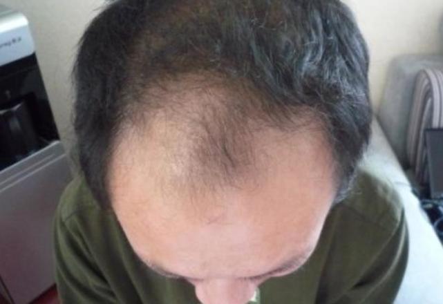 世界首家头发银行开业：冷冻头发样本，若秃顶可把细胞注射回头皮