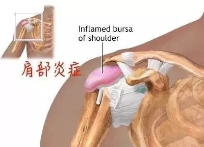 健身卧推肩膀受伤怎么恢复,卧推肩膀受限如何改善