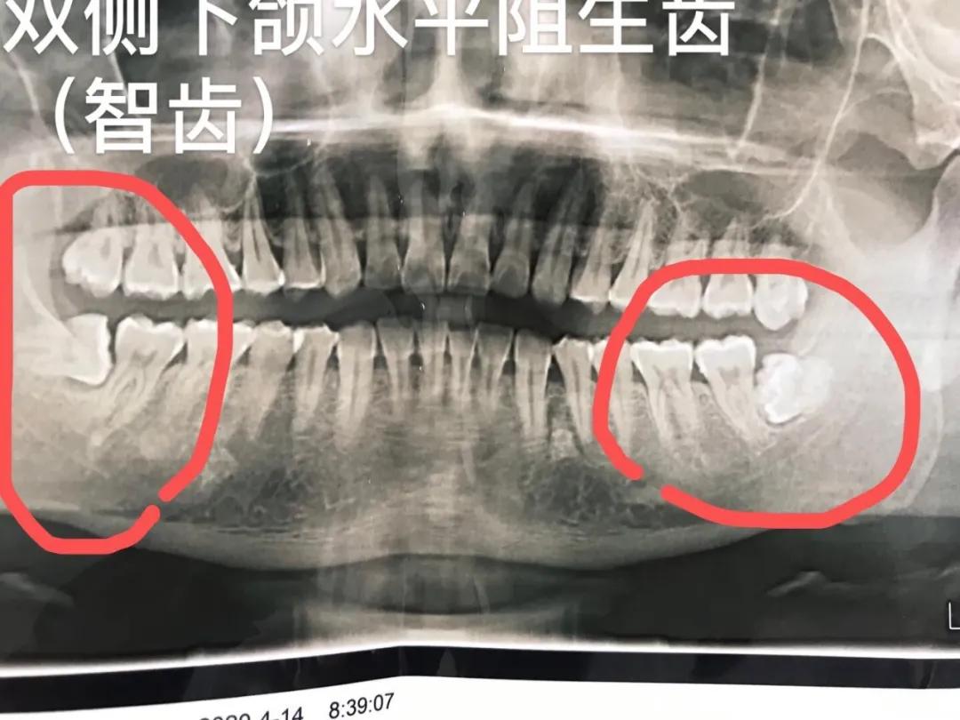 孕妇有牙病可以治吗,备孕牙齿上药需要注意啥