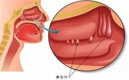 一文盘点｜临床上常见的息肉病