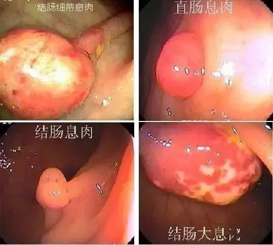 一文盘点｜临床上常见的息肉病