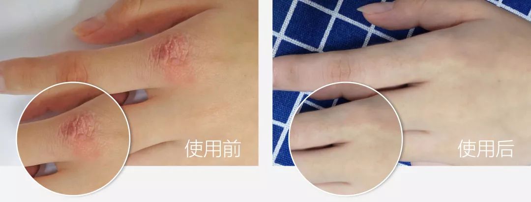 湿疹晒伤后抹什么药膏,日晒皮炎湿疹用什么止痒