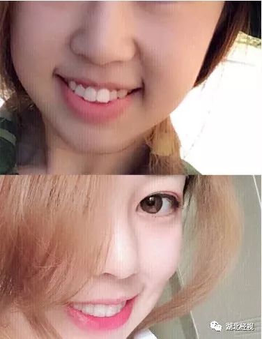 推广｜身份证42开头的注意！牙齿矫正、种植牙，这些全免费！