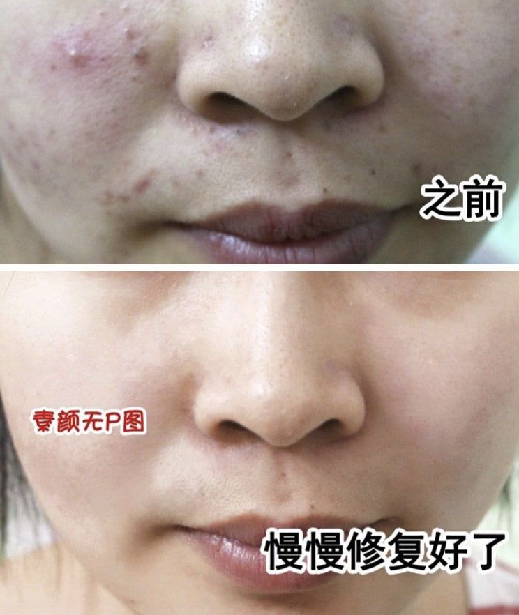 拒绝“螨虫脸”！5秒揉一揉，螨虫全出来了，痘痘黑头全没了