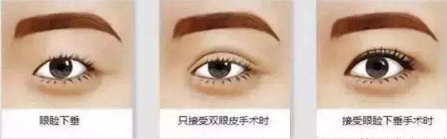 济南海峡整形医院整容案例,济南海峡整形医院割双眼皮怎么样