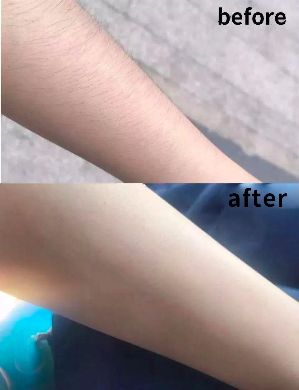 399元永久脱毛,618精选脱毛好物