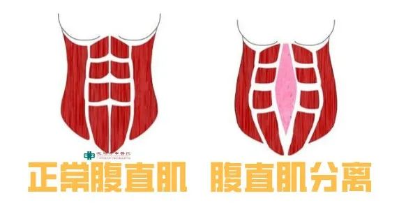 产后腹直肌分离针灸穴位图,产后针灸艾灸修复腹直肌盆底肌