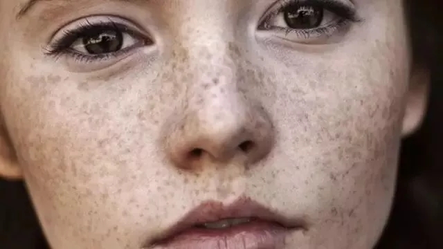 欧美美白祛斑,欧美祛斑美白