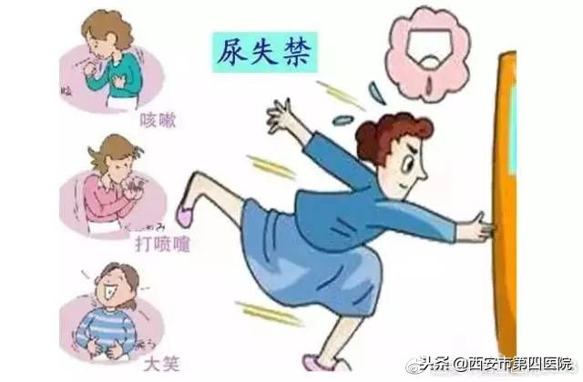 盆底肌最好的状态是怎么样的,了解盆底肌生物回馈治疗的要点