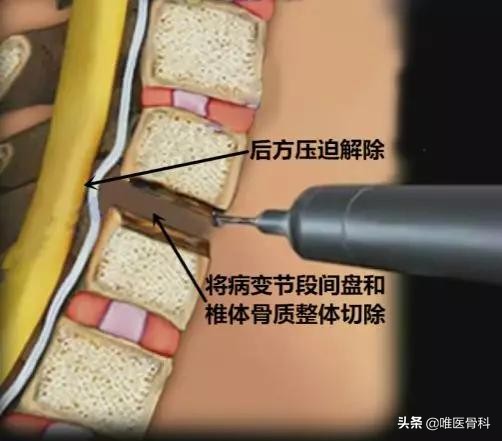 乳腺微创手术和开放手术的区别,开放手术和微创手术的区别