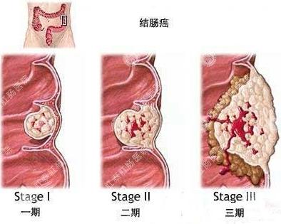 结肠癌是否可以预防,如何防结肠癌和直肠癌
