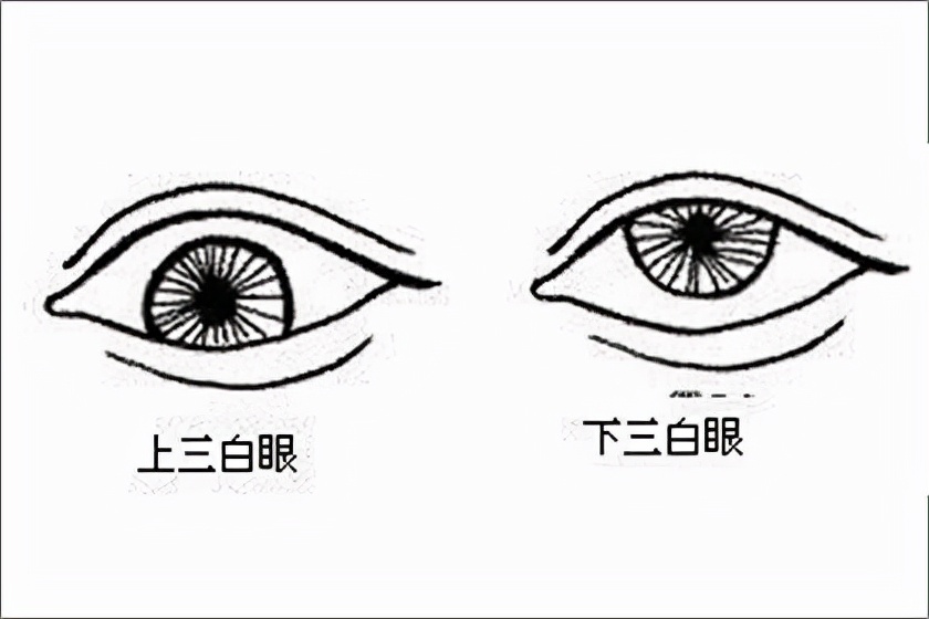 下三白眼长大后会改善吗,下三白眼的人如何手术矫正