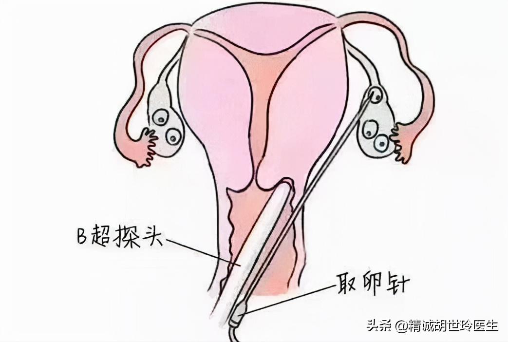 取完卵没有腹水多久可以移植冻胚,取了26个卵没腹水能移植吗