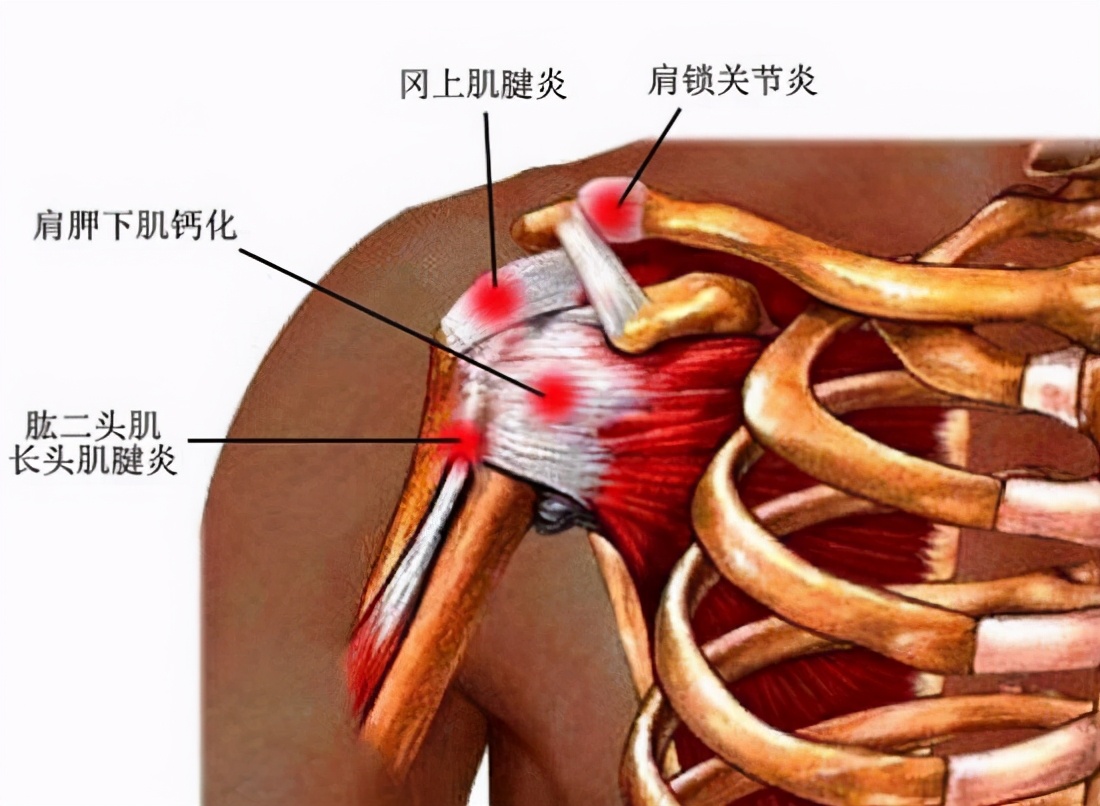 掰手腕导致肱二头肌肌腱损伤,肱二头肌肌腱损伤推拿治疗