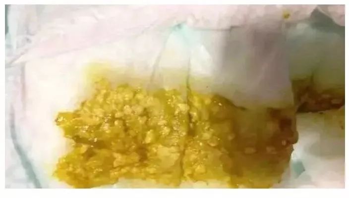 新婴儿大便怎样才是正常的,新生儿宝宝大便怎么判断是否正常