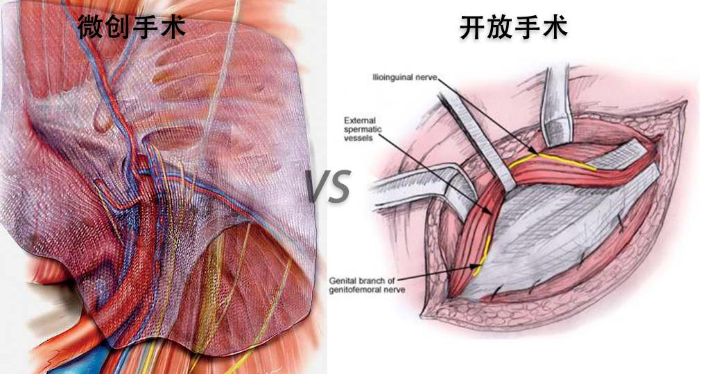 结石做微创手术全过程,十年前的结石终于手术了