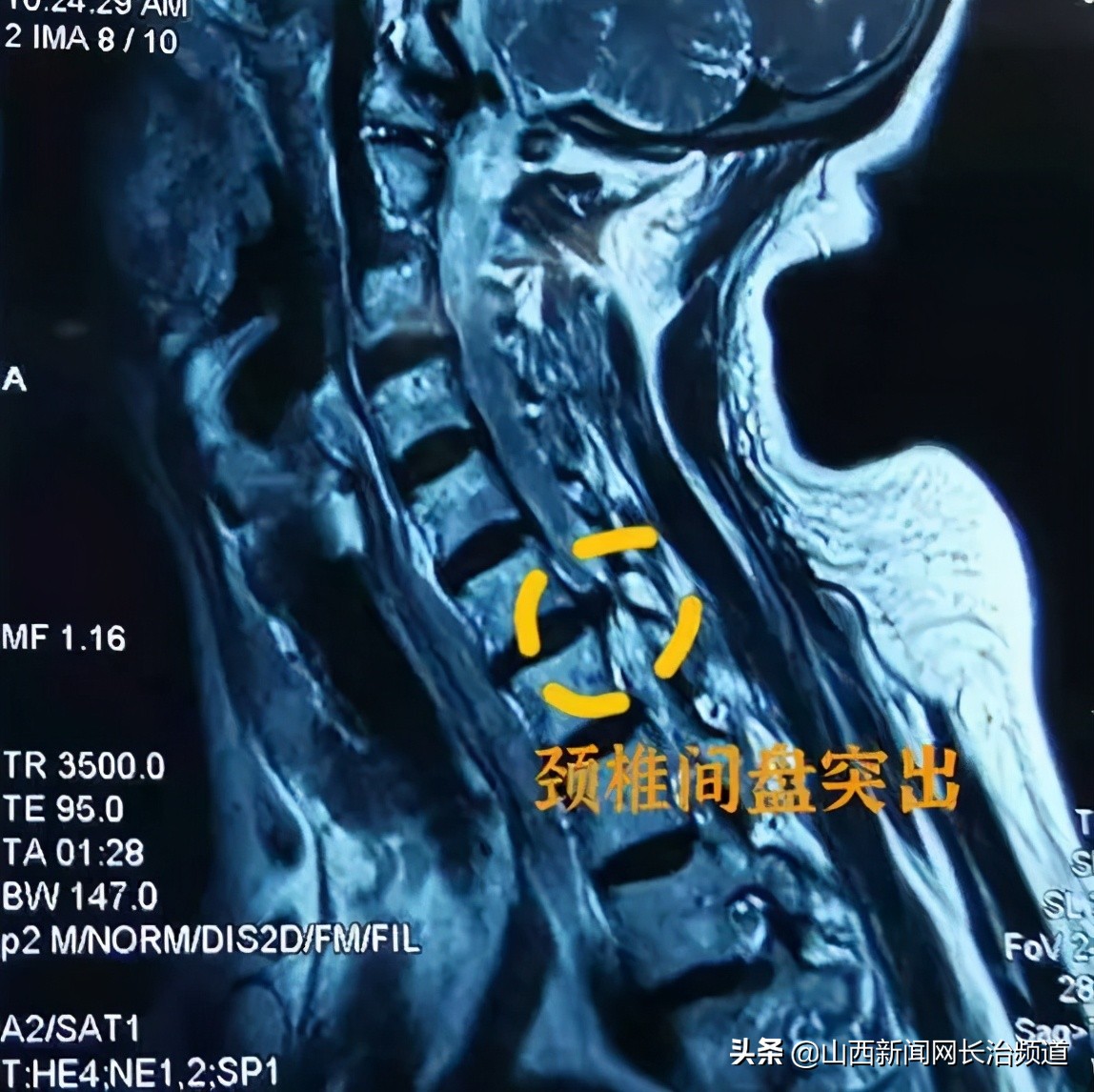 和平技术|疼起来要命的颈椎，一个“钥匙孔”搞定