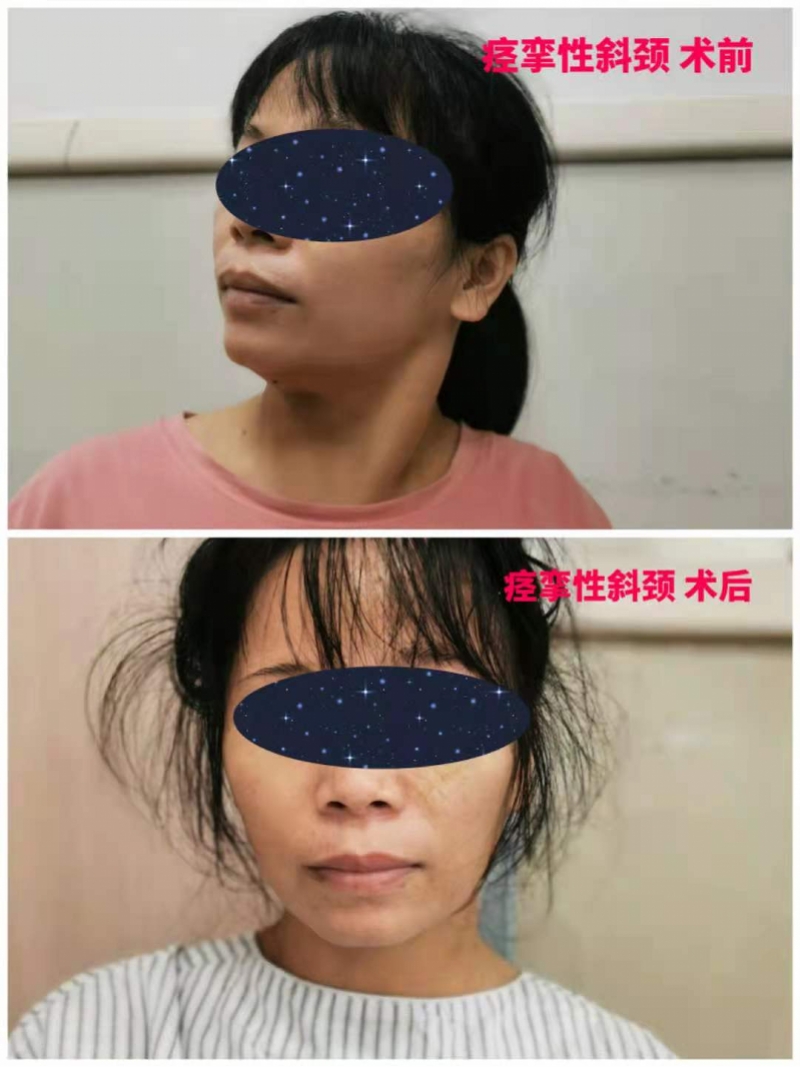 矫正脖子歪的手术是怎样的,治疗歪颈视频