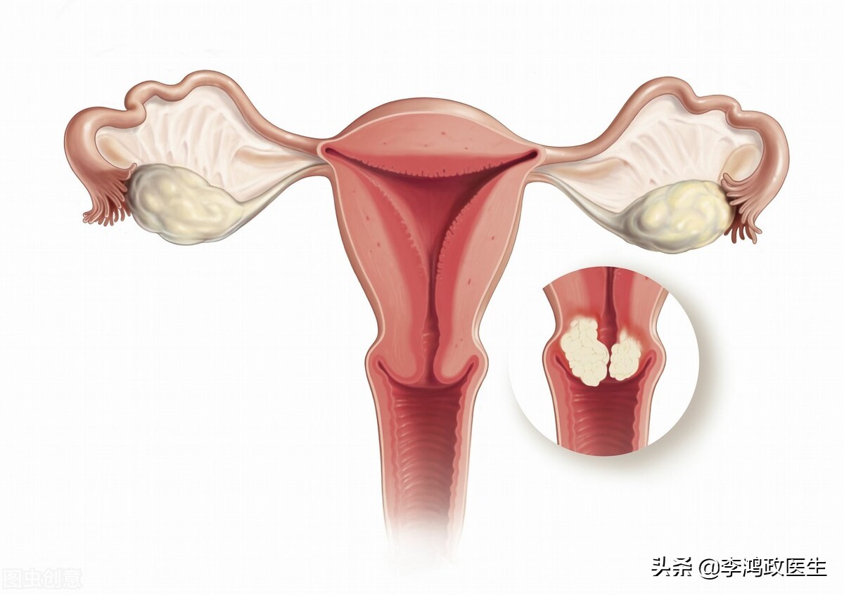 女子做手术疼痛难忍,肚子痛流血是什么妇科病