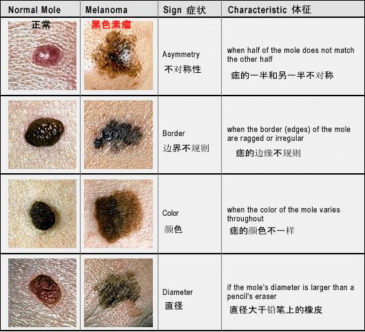 癌变的10种痣图片黑色素瘤,普通的痣和黑色素瘤有什么区别