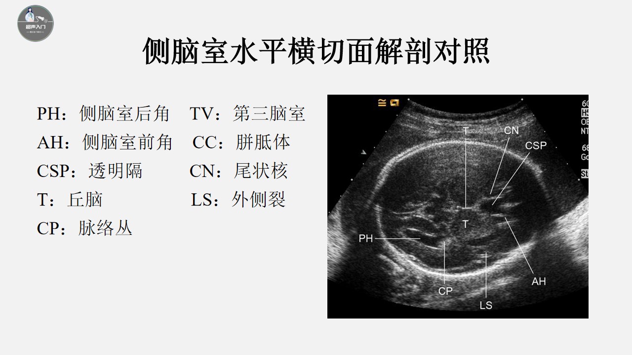 胎儿颅脑超声标准切面图解,胎儿颅脑异常的超声诊断ppt