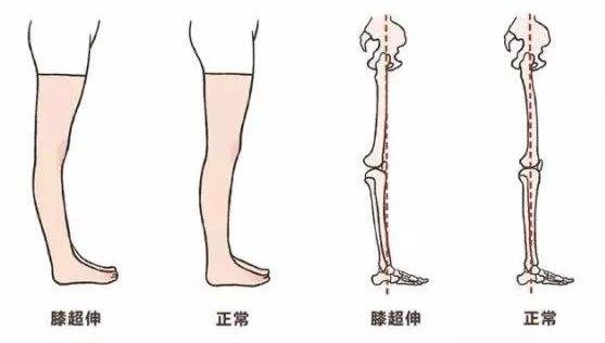 躺在床上矫正小腿外翻,小腿外翻如何矫正和站立