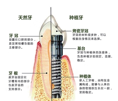 种植牙真的很好吗,种植牙副作用多吗