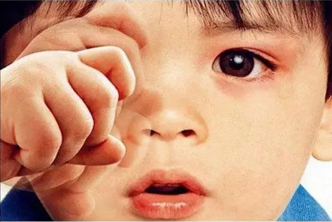 孩子眨眼频繁并脸部抽动,孩子频繁眨眼眼睛往上翻