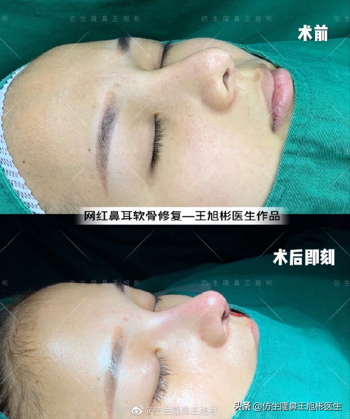不想鼻子变得坑坑洼洼,不想整容想让鼻子挺起来