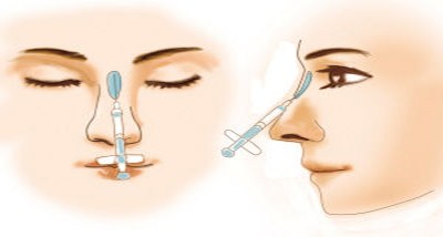 天生鼻型不完美怎么办呢,8种最丑鼻子合集
