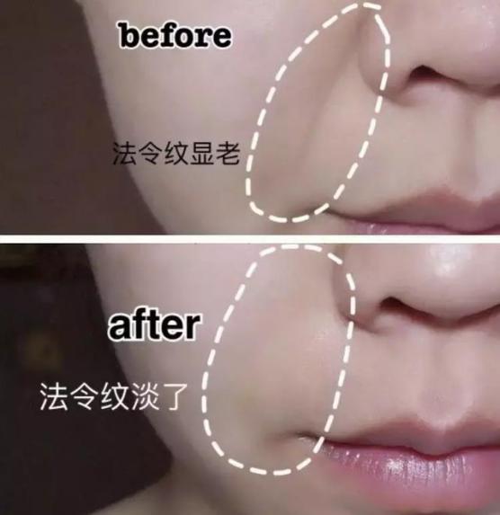 硬刚女皇龙妈也扛不住法令纹，2条沟壑让人心疼，贴一贴就消了