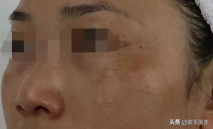 脸上斑斑点点最佳治疗方法,脸上斑斑点点小妙招