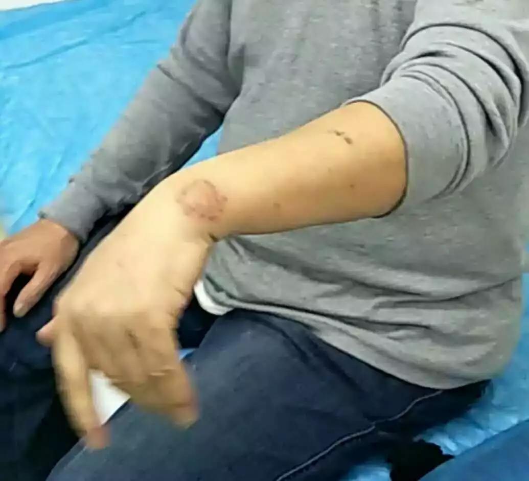 人体有“极联”，交经缪刺，左右互治——肢体关节痛一针效果显
