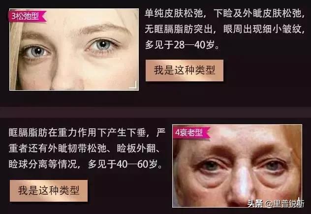 祖传药膏去除眼袋,祖传治疗眼袋
