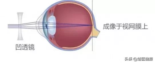 眼科激光手术靠谱吗,眼科医院近视矫正靠谱么