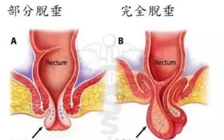 肛肠痔瘘的症状有哪些,痔疮肛裂肛窦炎怎么治
